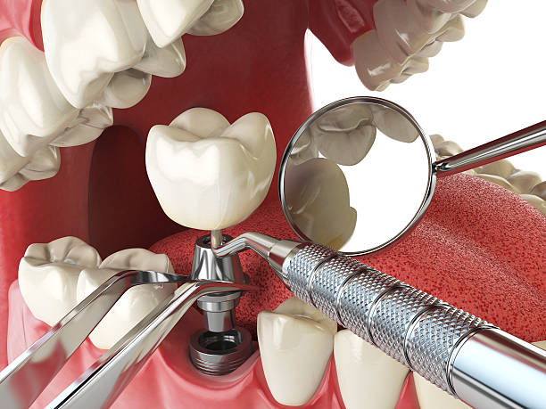 Best Emergency Root Canal Therapy in Discovery Bay, CA